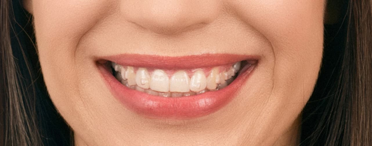 Clear aligner patient